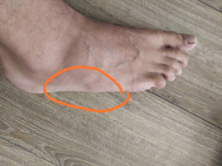 Debutant Avec Forte Douleur Exterieur Du Pied Apres Repos Conseils Course A Pied